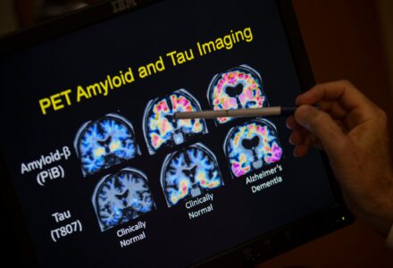 [GIẢI MÃ] CƠ CHẾ BỆNH ALZHEIMER: CUỘC CHIẾN HÓA HỌC THẦM LẶNG BÊN TRONG NÃO BỘ