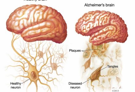 CÁC GIAI ĐOẠN TIẾN TRIỂN CỦA ALZHEIMER: TỪ NHỮNG “TÍN HIỆU” MƠ HỒ ĐẾN SUY GIẢM CHỨC NĂNG NGHIÊM TRỌNG